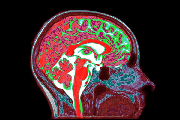 Brain Mri sagittal view 2