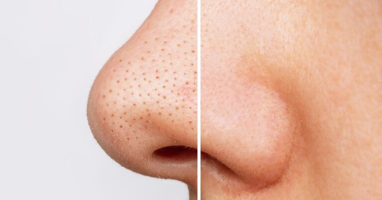 blackheads before after mario badescu silver powder